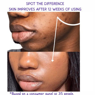 Khichi Beauty Dark Spots Corrector - Khichi Beauty Skincare by WWW.ALESMAXII.COM